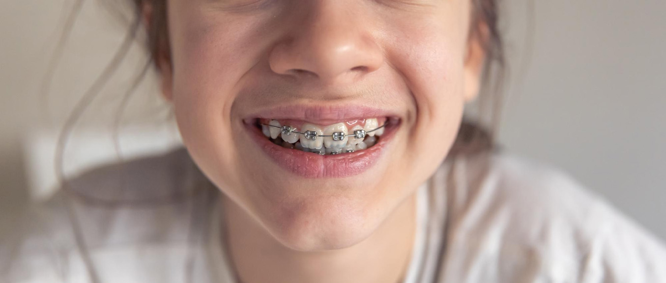 What is the Best Age for Braces? A Parent's Guide to Your Child's Smile
