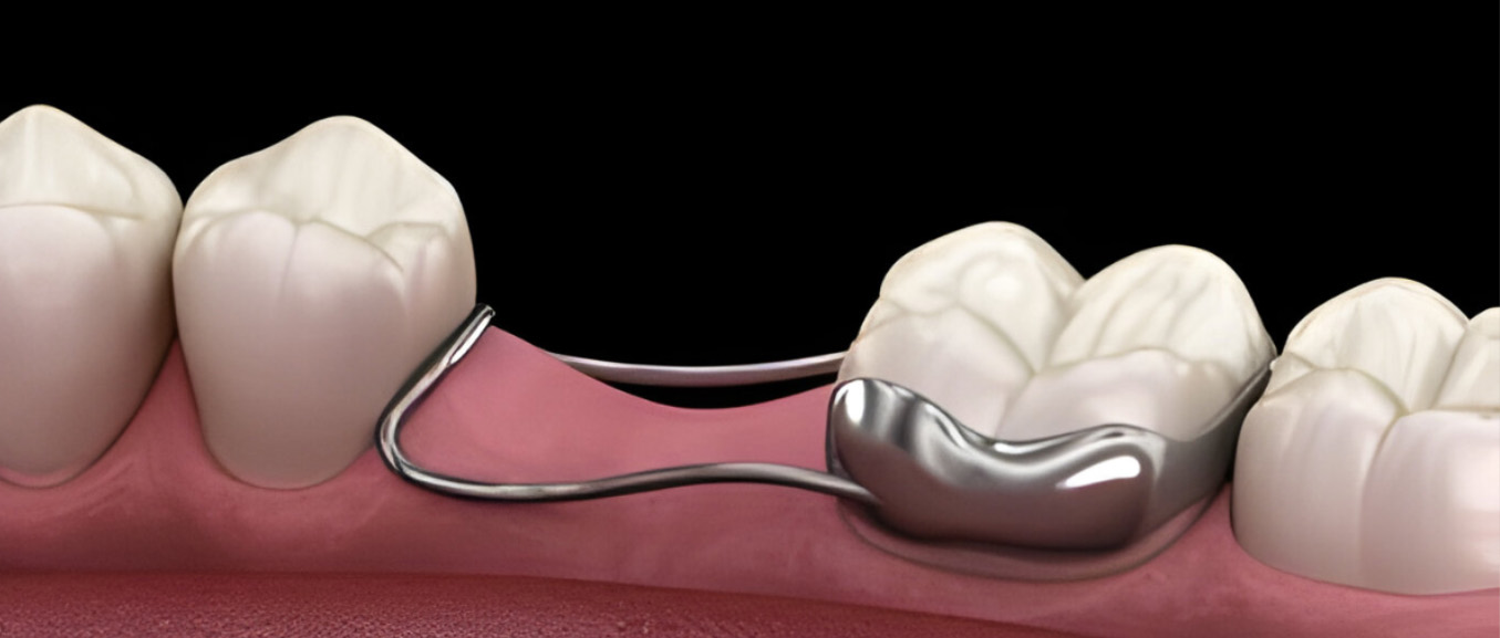 What Is a Dental Space Maintainer?  Types, Benefits, and When It’s Needed