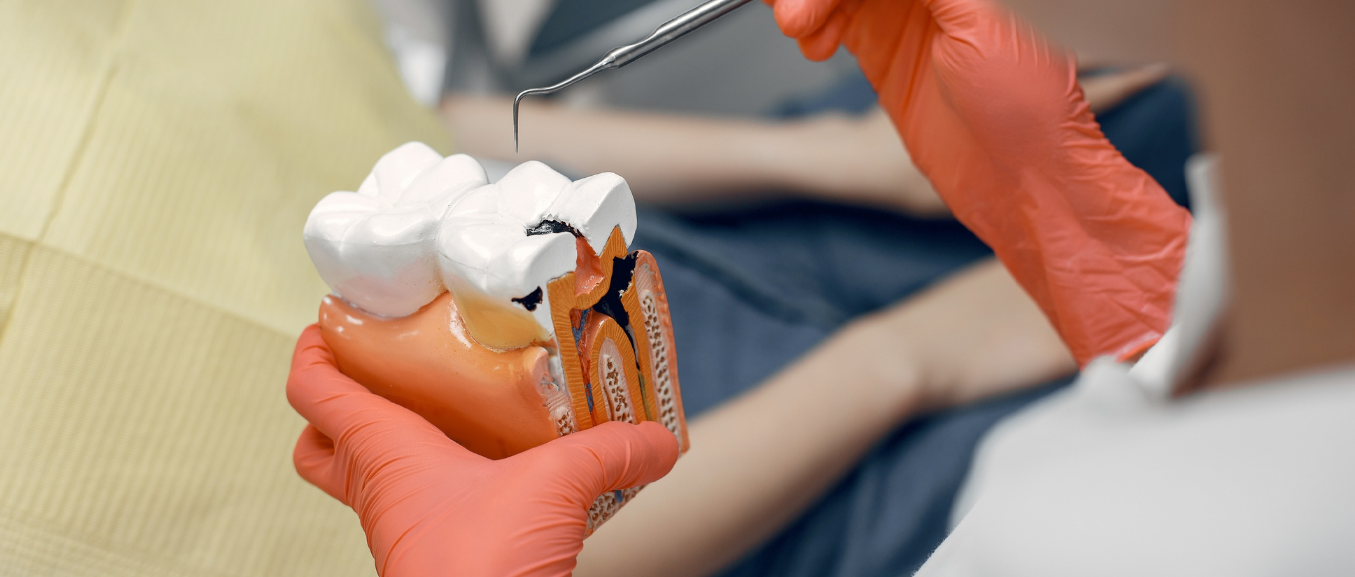What Is Gutta Percha? The Root Canal Filling Material Explained for Patients