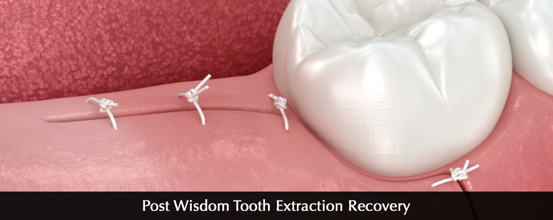 post wisdom tooth extraction recovery