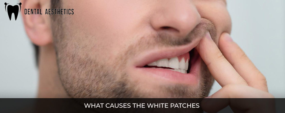 what causes the white patches