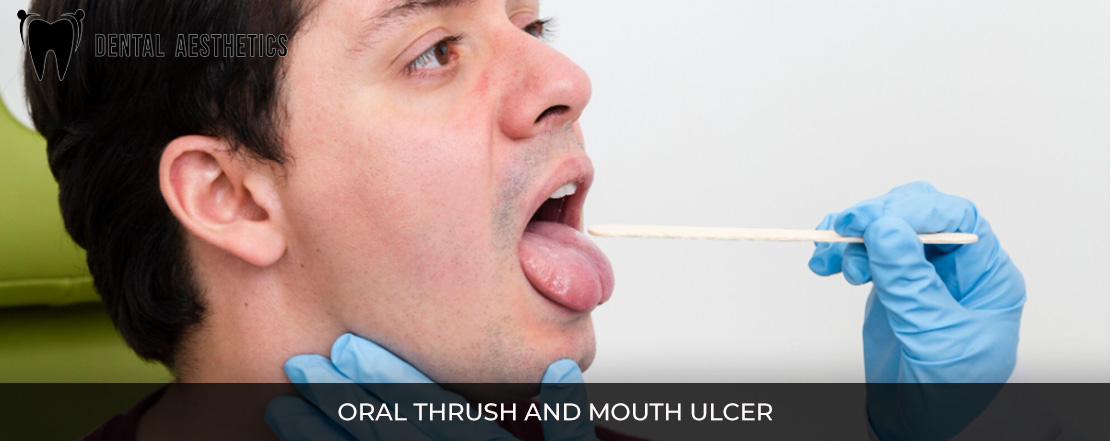 oral thrush and mouth ulcer