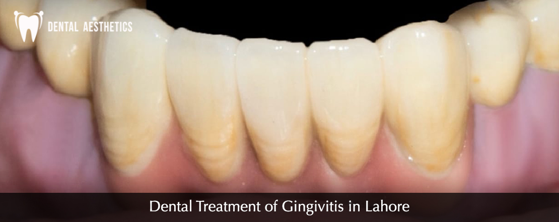 Dental Treatment of Gingivitis in Lahore
