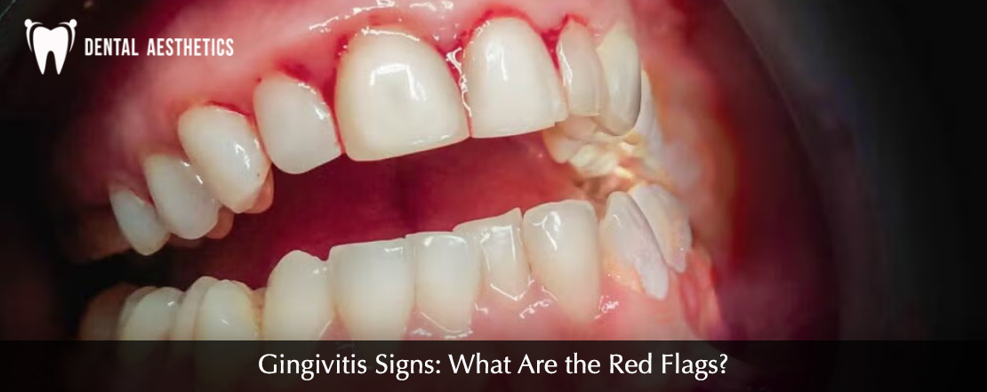 Gingivitis Signs red flags