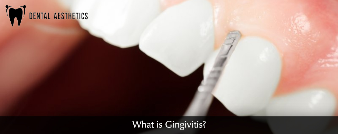 what Gingivitis