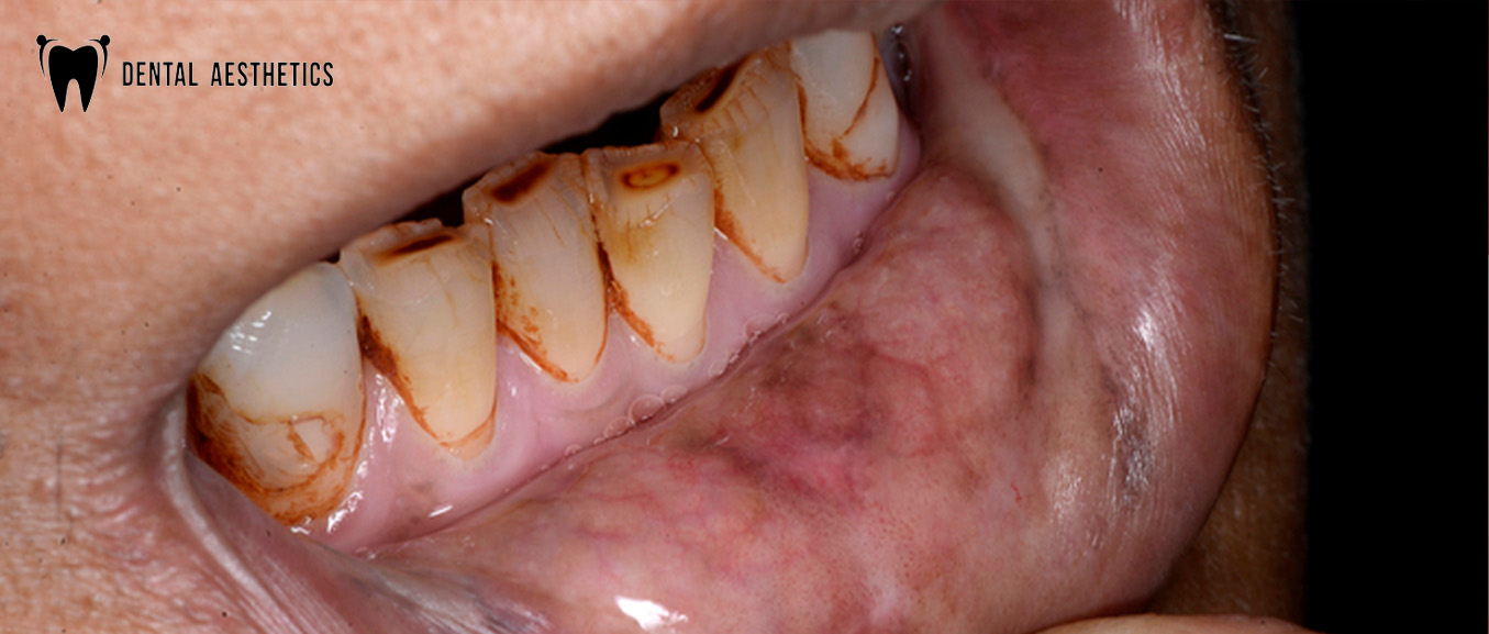 Mouth Burns After Paan? It Could Be Oral Submucous Fibrosis. Here's What Yout Need to Know