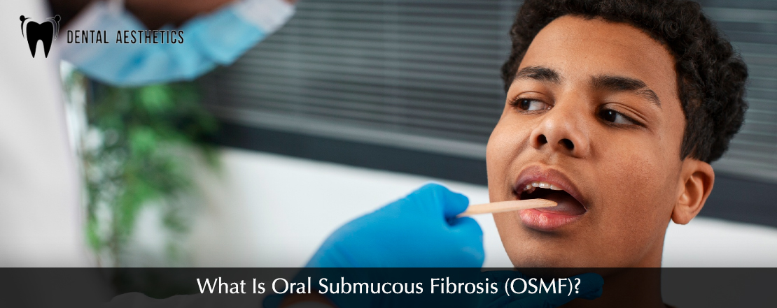 what is Oral Submucous Fibrosis