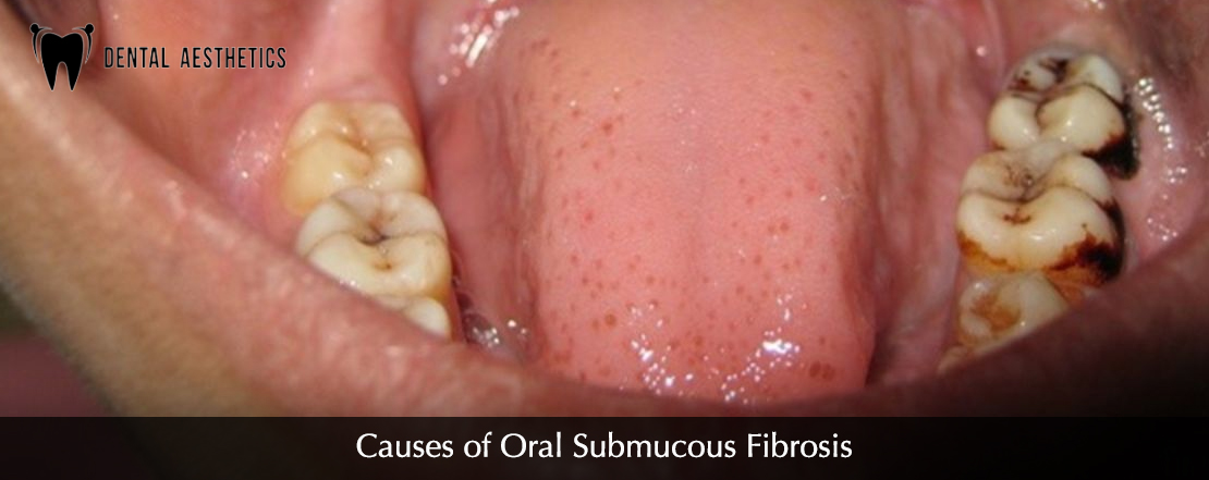 causes of Oral Submucous