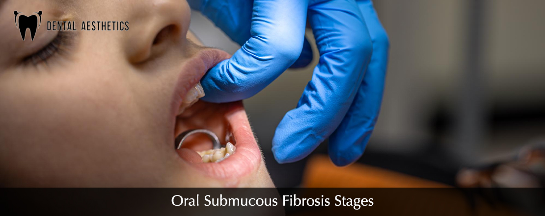 Submucous Fibrosis