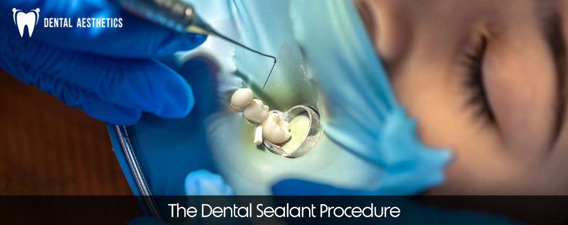 the dental sealant procedure