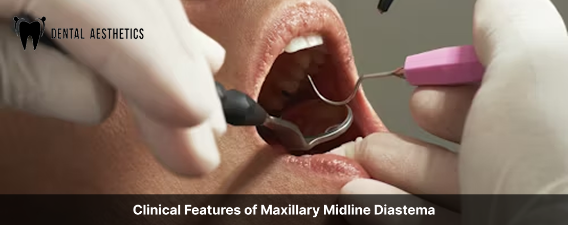 clinical feature of maxillary midline diastema