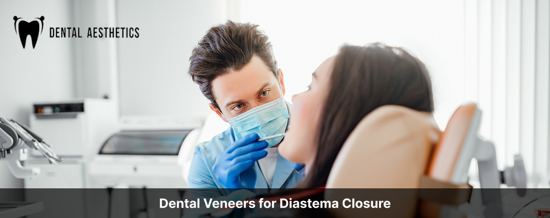dental veneers for diastema closure