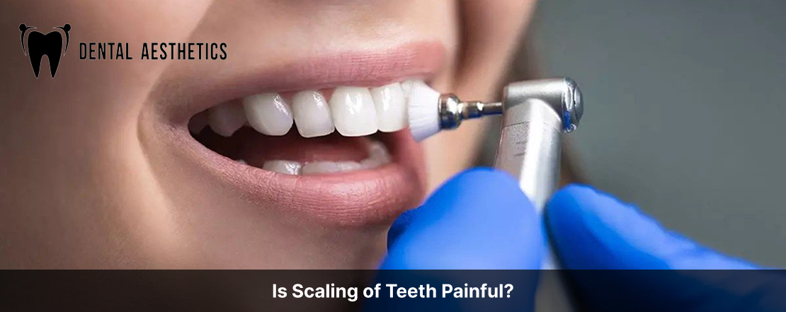 Is Scaling of Teeth Painful?