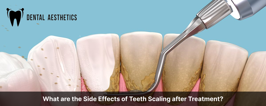 What are the Side Effects of Teeth Scaling after Treatment?