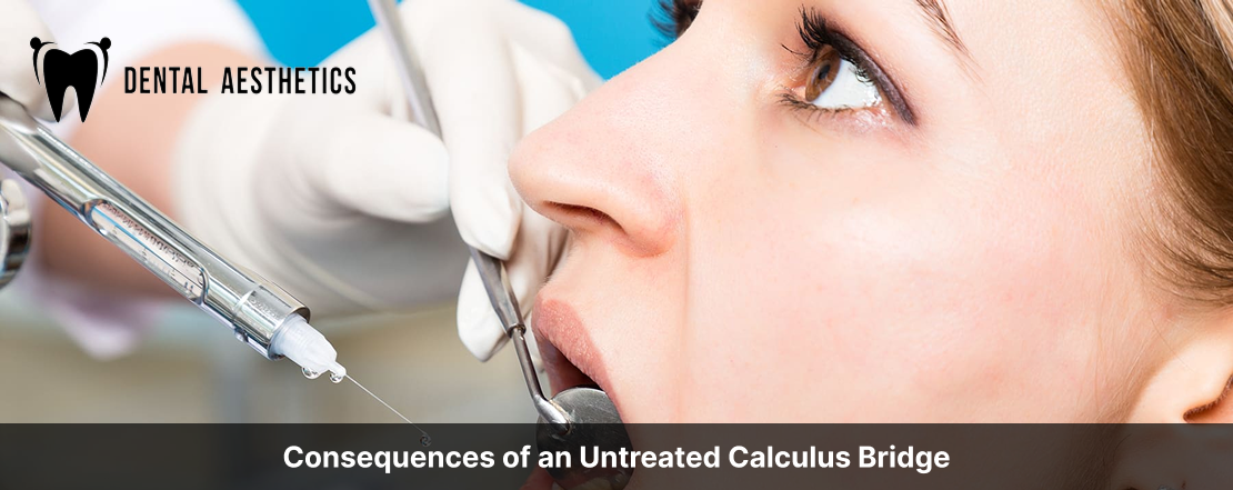 consequences of an untreated calculus bridge