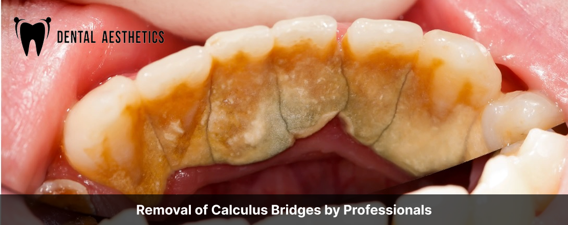 removal of calculus bridges by professionals