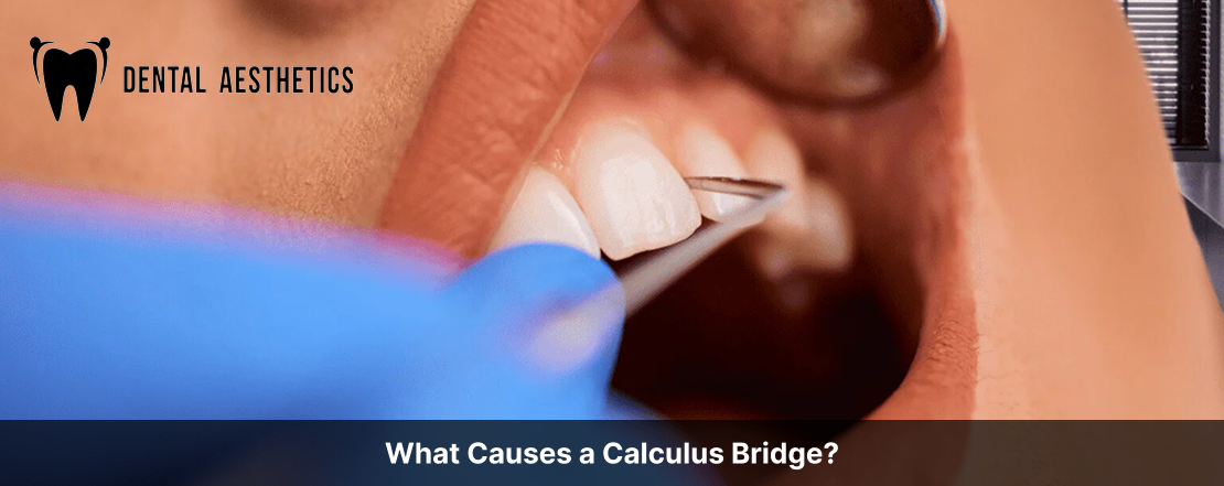 what causes a calculus bridge