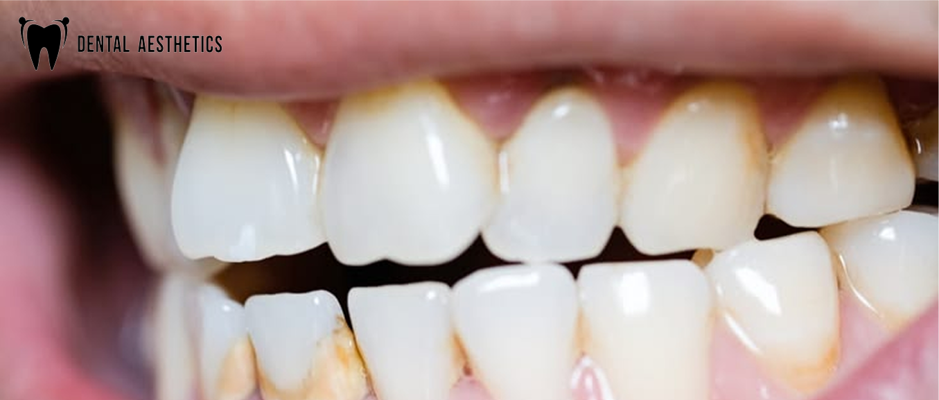 What is a Calculus Bridge? Causes, Warning Signs, and Removal in Lahore