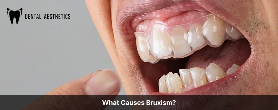 what causes bruxism