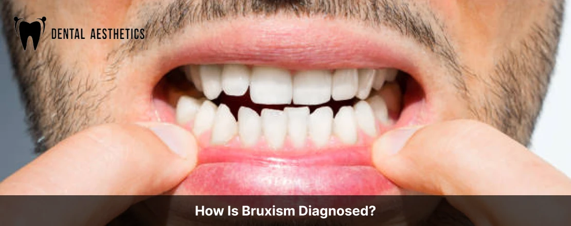 how is bruxism diagnosed