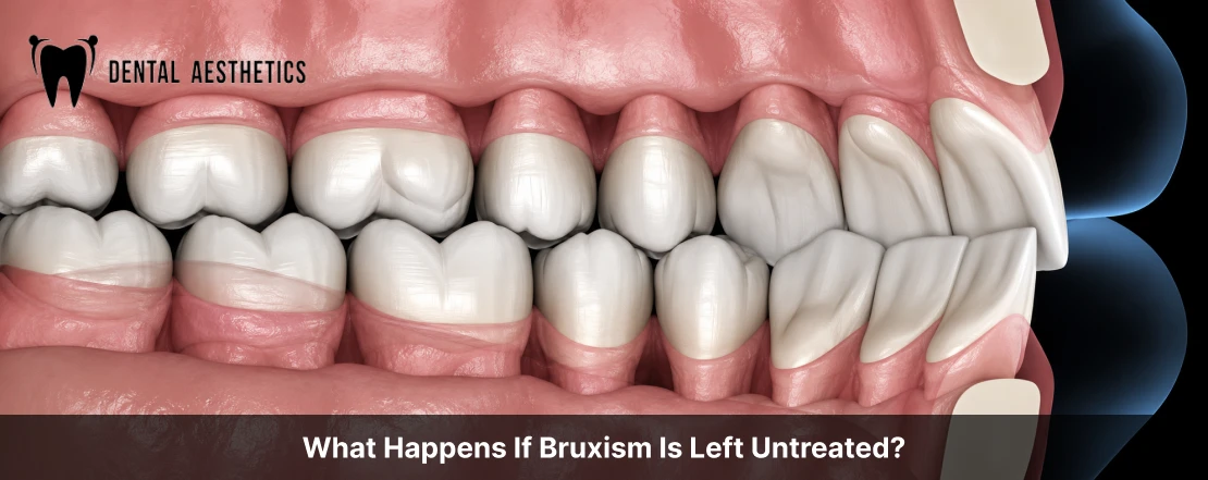 what happens if bruxism is left untreated