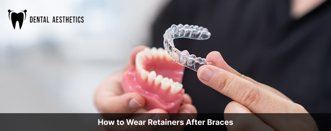 How to Wear Retainers After Braces