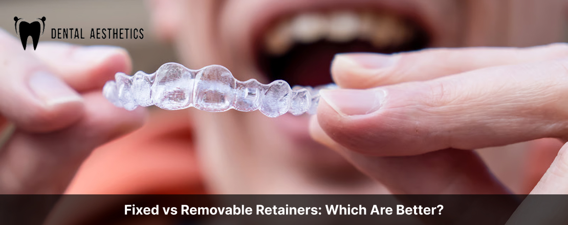 Fixed vs Removable Retainers: Which Are Better?