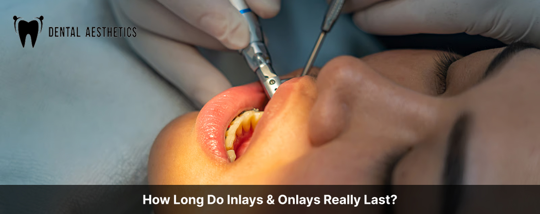 How Long Do Inlays & Onlays Really Last?