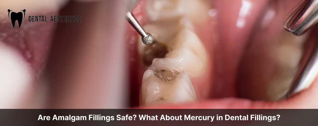 Are Amalgam Fillings Safe? What About Mercury in Dental Fillings?