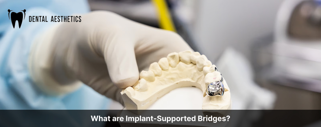What are Implant-Supported Bridges?