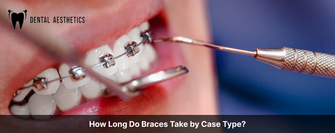 How Long Do Braces Take by Case Type?