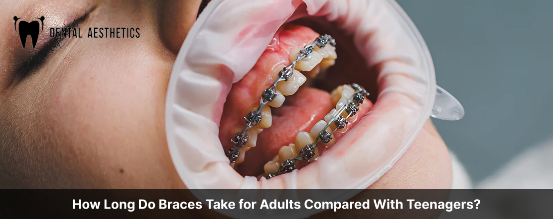 How Long Do Braces Take for Adults Compared With Teenagers?