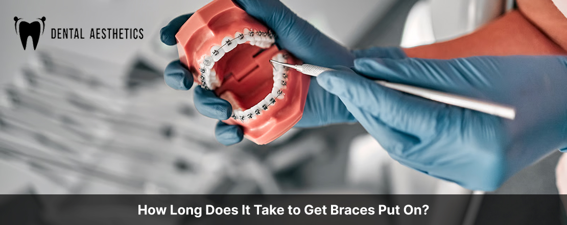 How Long Does It Take to Get Braces Put On?