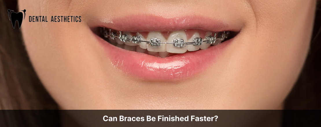 Can Braces Be Finished Faster?