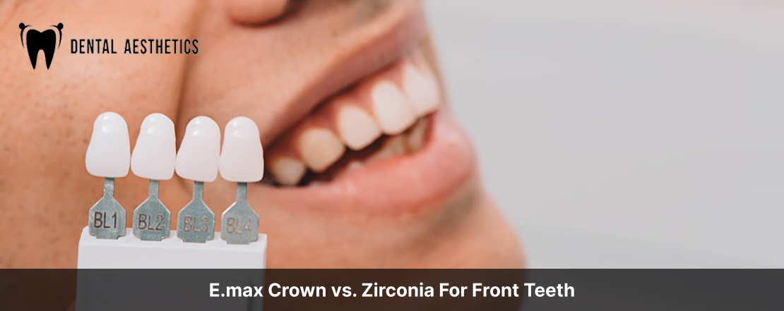E.max Crown vs. Zirconia For Front Teeth